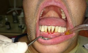 “AQS dental center” tövsiyə edir: diş ərplərindən necə xilas olmalı?