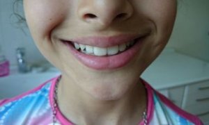 “AQS dental center” tövsiyə edir: Diş restavrasiyalarında fərqli üsul