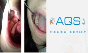 “AQS dental center” tövsiyə edir: Inley və Onley – estetik restovrasiya üsulu