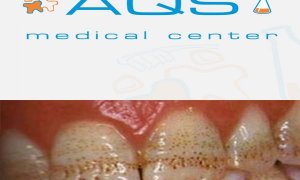 “AQS dental center” tövsiyə edir – Çilli dişlər: flüoroz