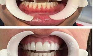 Dişlərinizi qoruyun, yoxsa… – “AQS dental center”dən TÖVSİYƏ