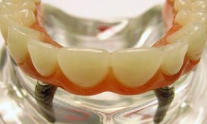 Diş implantları təhlükəli imiş – ALİMLƏRDƏN XƏBƏRDARLIQ